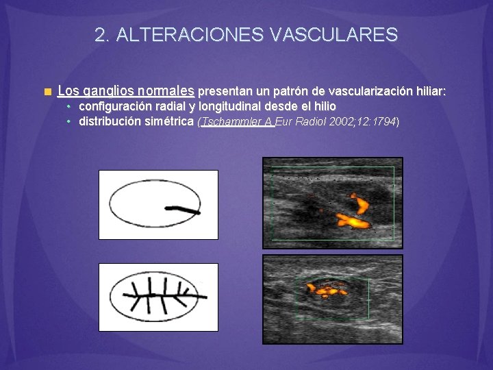 2. ALTERACIONES VASCULARES Los ganglios normales presentan un patrón de vascularización hiliar: • configuración