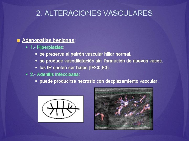 2. ALTERACIONES VASCULARES Adenopatías benignas: § 1. - Hiperplasias: § se preserva el patrón