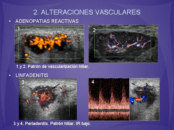 2. ALTERACIONES VASCULARES • ADENOPATIAS REACTIVAS 1 2 1 y 2. Patrón de vascularización