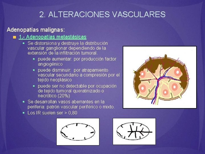 2. ALTERACIONES VASCULARES Adenopatías malignas: 1. - Adenopatías metastásicas: § Se distorsiona y destruye