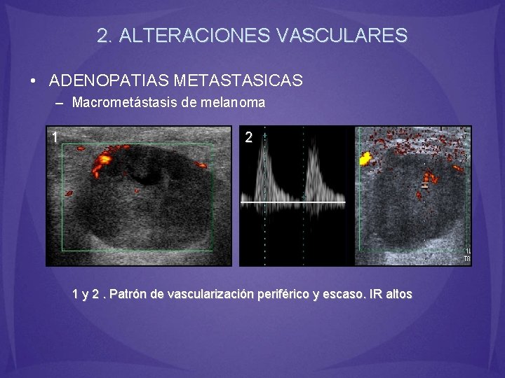 2. ALTERACIONES VASCULARES • ADENOPATIAS METASTASICAS – Macrometástasis de melanoma 1 2 1 y