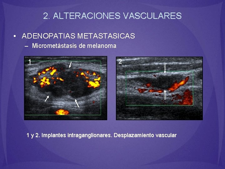 2. ALTERACIONES VASCULARES • ADENOPATIAS METASTASICAS – Micrometástasis de melanoma 1 2 1 y