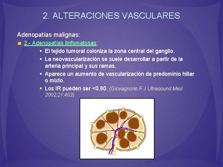 2. ALTERACIONES VASCULARES Adenopatías malignas: 2. - Adenopatías linfomatosas: § El tejido tumoral coloniza