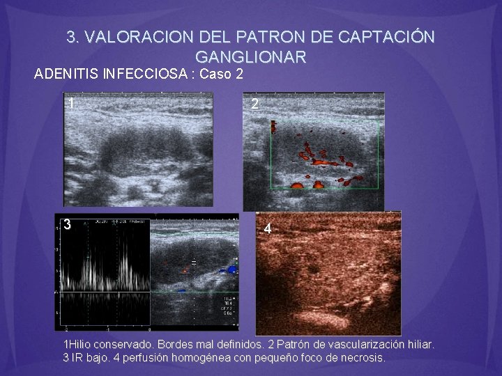 3. VALORACION DEL PATRON DE CAPTACIÓN GANGLIONAR ADENITIS INFECCIOSA : Caso 2 1 3