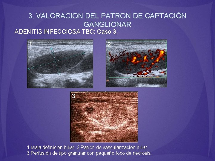 3. VALORACION DEL PATRON DE CAPTACIÓN GANGLIONAR ADENITIS INFECCIOSA TBC: Caso 3. 1 2