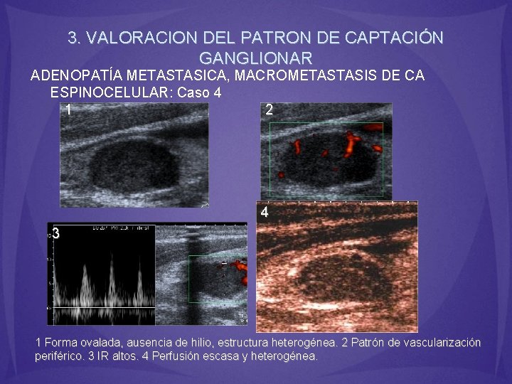 3. VALORACION DEL PATRON DE CAPTACIÓN GANGLIONAR ADENOPATÍA METASTASICA, MACROMETASTASIS DE CA ESPINOCELULAR: Caso