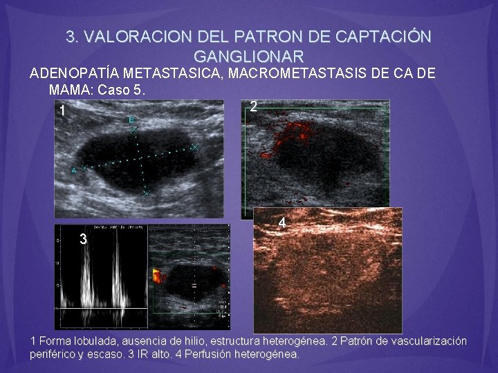 3. VALORACION DEL PATRON DE CAPTACIÓN GANGLIONAR ADENOPATÍA METASTASICA, MACROMETASTASIS DE CA DE MAMA: