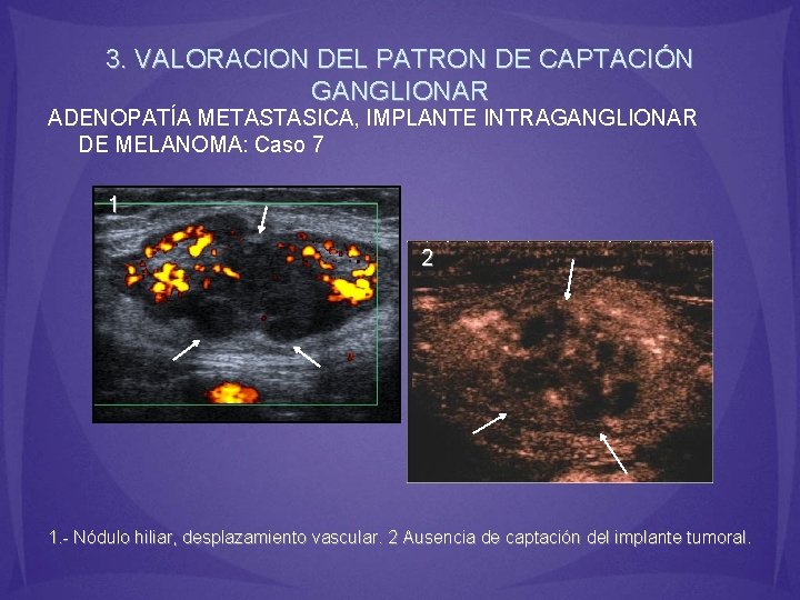 3. VALORACION DEL PATRON DE CAPTACIÓN GANGLIONAR ADENOPATÍA METASTASICA, IMPLANTE INTRAGANGLIONAR DE MELANOMA: Caso