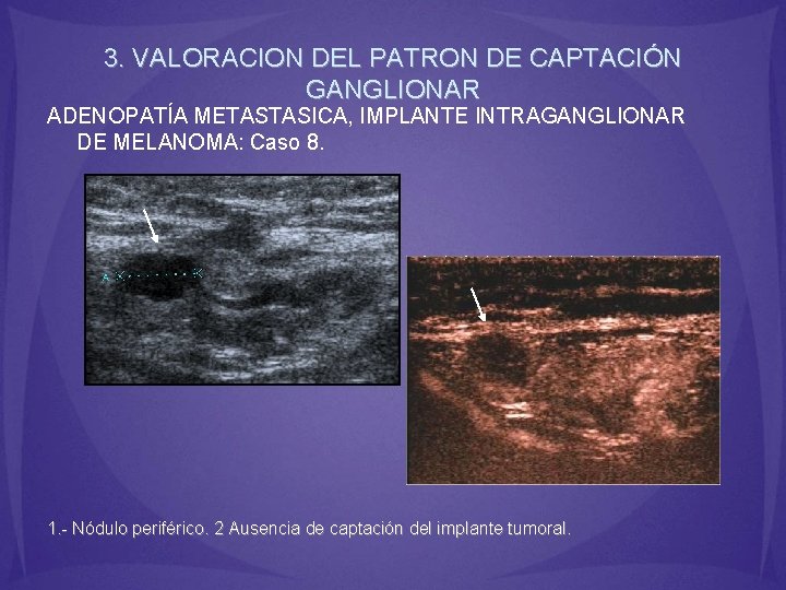 3. VALORACION DEL PATRON DE CAPTACIÓN GANGLIONAR ADENOPATÍA METASTASICA, IMPLANTE INTRAGANGLIONAR DE MELANOMA: Caso