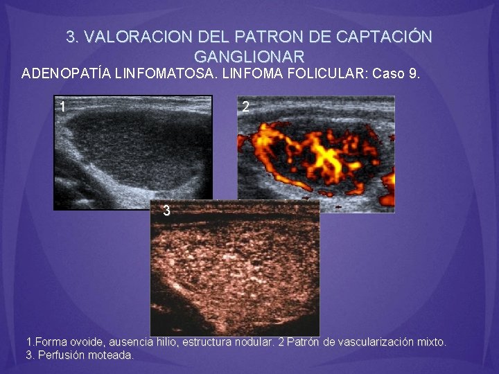 3. VALORACION DEL PATRON DE CAPTACIÓN GANGLIONAR ADENOPATÍA LINFOMATOSA. LINFOMA FOLICULAR: Caso 9. 1