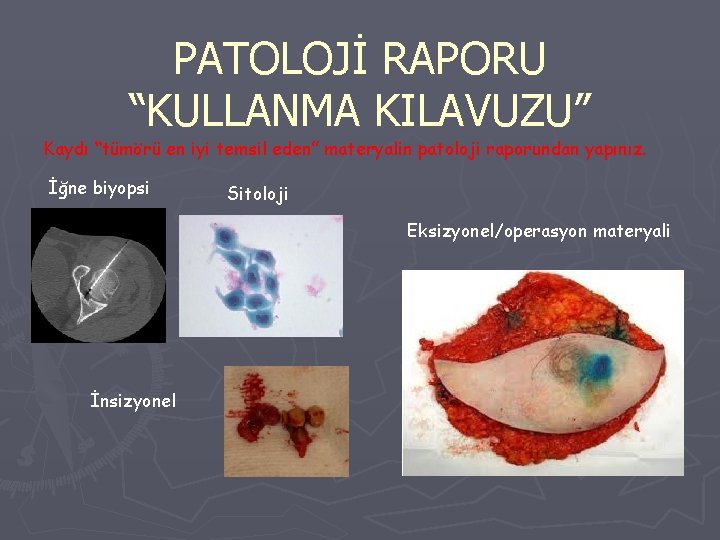 PATOLOJİ RAPORU “KULLANMA KILAVUZU” Kaydı “tümörü en iyi temsil eden” materyalin patoloji raporundan yapınız.