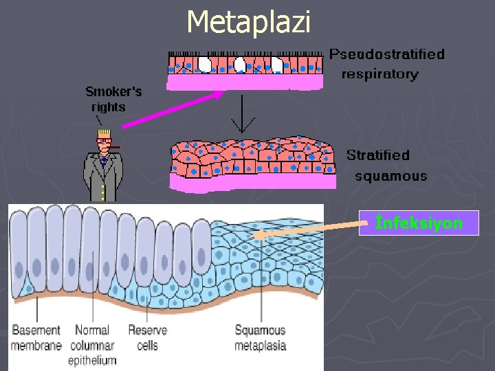 Metaplazi İnfeksiyon 