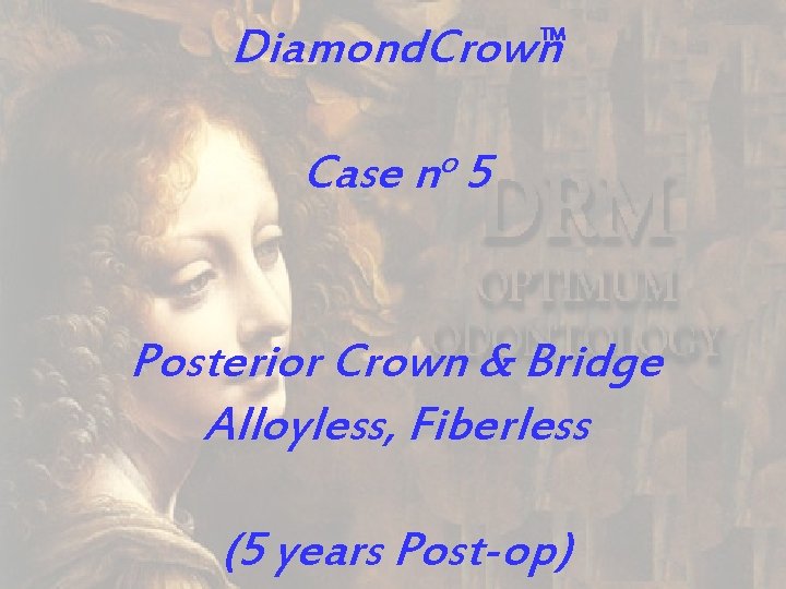 Diamond. Crown TM o Case n 5 Posterior Crown & Bridge Alloyless, Fiberless (5