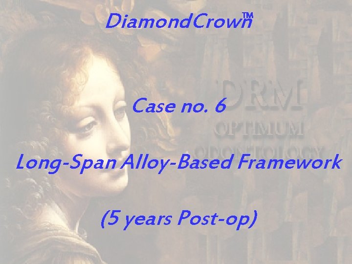 Diamond. Crown TM Case no. 6 Long-Span Alloy-Based Framework (5 years Post-op) 