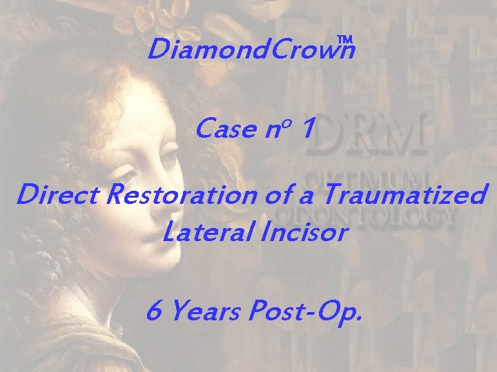 Diamond. Crown TM o Case n 1 Direct Restoration of a Traumatized Lateral Incisor