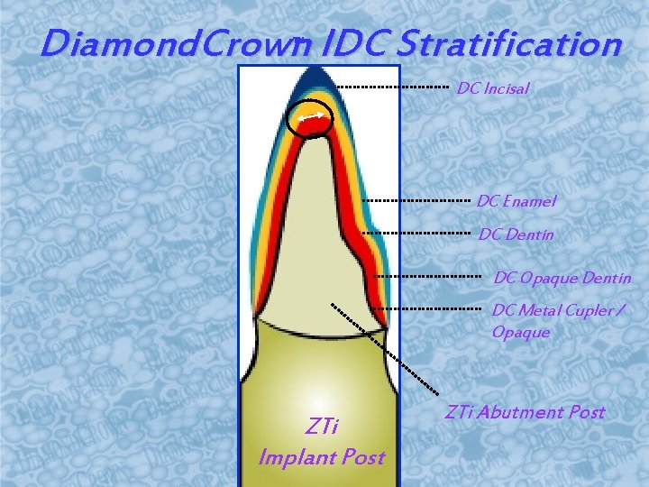 Diamond. Crown IDC Stratification TM DC Incisal DC Enamel DC Dentin DC Opaque Dentin