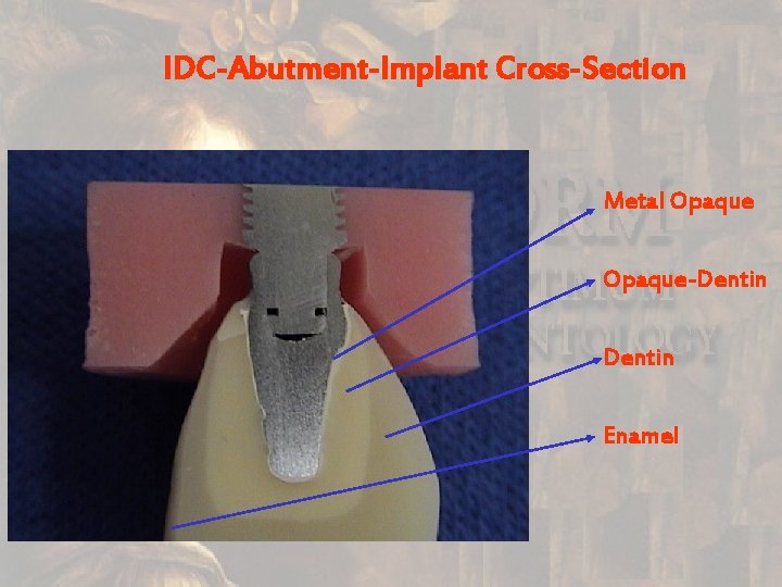 IDC-Abutment-Implant Cross-Section Metal Opaque-Dentin Enamel 