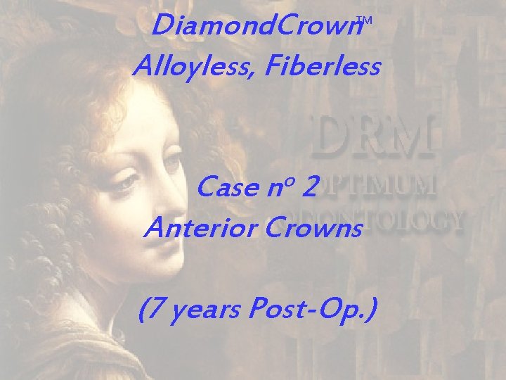 Diamond. Crown Alloyless, Fiberless TM Case no 2 Anterior Crowns (7 years Post-Op. )