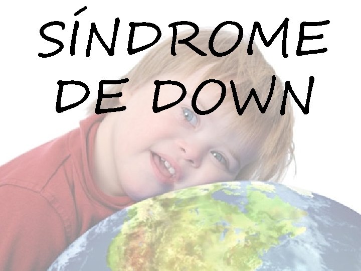 SÍNDROME DE DOWN 