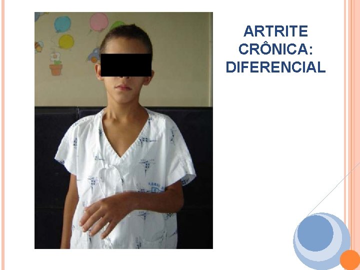 ARTRITE CRÔNICA: DIFERENCIAL ARTRITE CRÔNICA: DIFERENCIAL