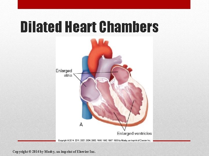 Dilated Heart Chambers Copyright © 2014 by Mosby, an imprint of Elsevier Inc. 