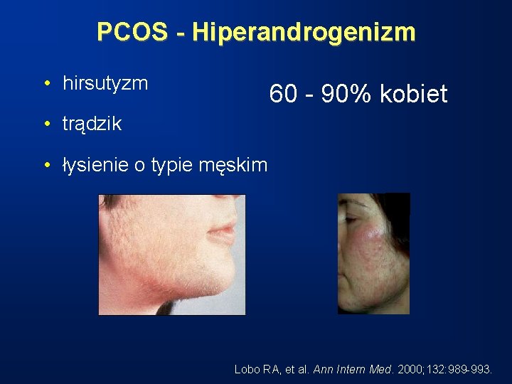 PCOS - Hiperandrogenizm • hirsutyzm 60 - 90% kobiet • trądzik • łysienie o