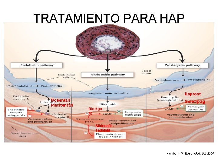 TRATAMIENTO PARA HAP Iloprost Bosentan Macitentán Selexipag Riocigu at Sildenafil Tadalafil Humbert, N Eng