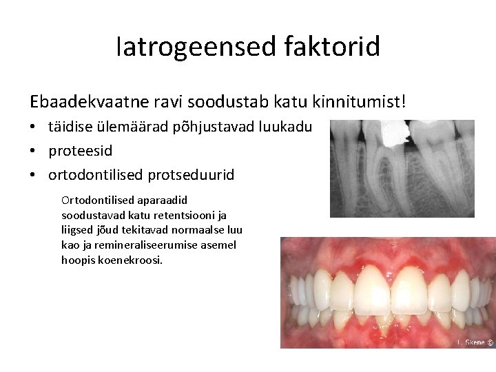 Iatrogeensed faktorid Ebaadekvaatne ravi soodustab katu kinnitumist! • täidise ülemäärad põhjustavad luukadu • proteesid