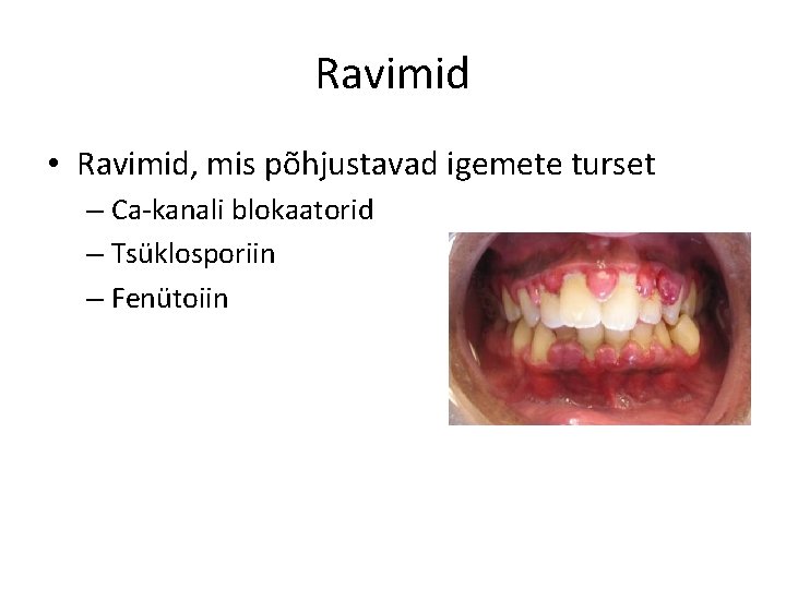 Ravimid • Ravimid, mis põhjustavad igemete turset – Ca-kanali blokaatorid – Tsüklosporiin – Fenütoiin