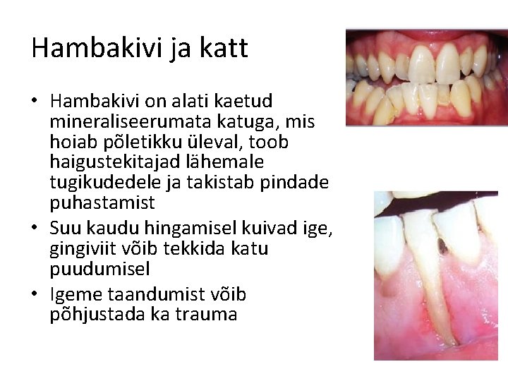 Hambakivi ja katt • Hambakivi on alati kaetud mineraliseerumata katuga, mis hoiab põletikku üleval,