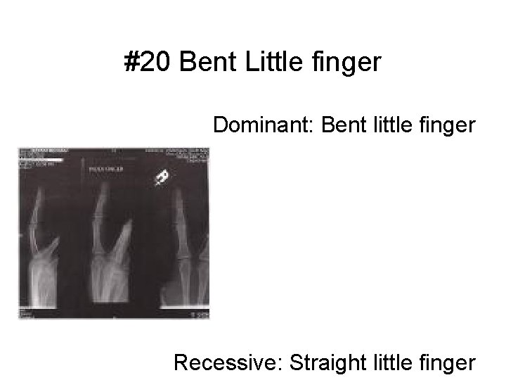 #20 Bent Little finger Dominant: Bent little finger Recessive: Straight little finger 