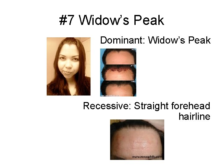 #7 Widow’s Peak Dominant: Widow’s Peak Recessive: Straight forehead hairline 