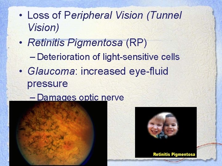  • Loss of Peripheral Vision (Tunnel Vision) • Retinitis Pigmentosa (RP) – Deterioration