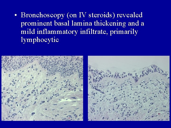  • Bronchoscopy (on IV steroids) revealed prominent basal lamina thickening and a mild