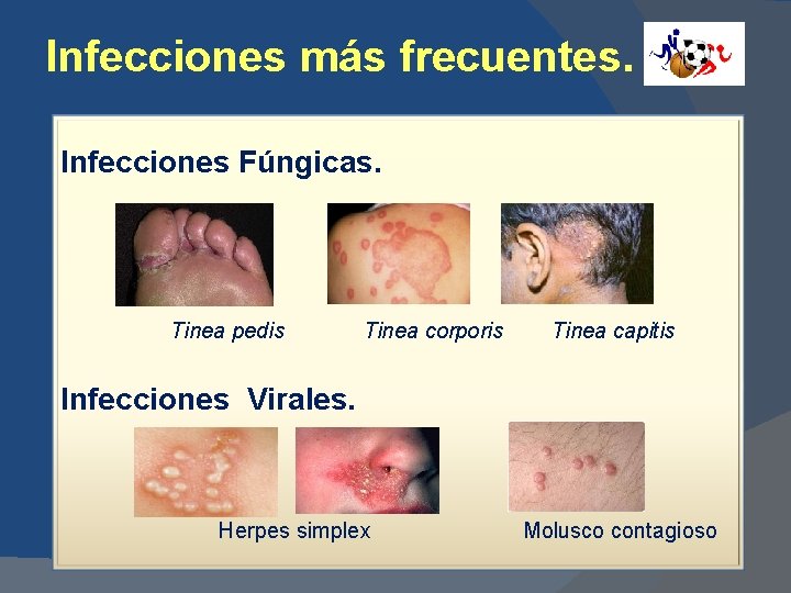 Infecciones más frecuentes. Infecciones Fúngicas. Tinea pedis Tinea corporis Tinea capitis Infecciones Virales. Herpes