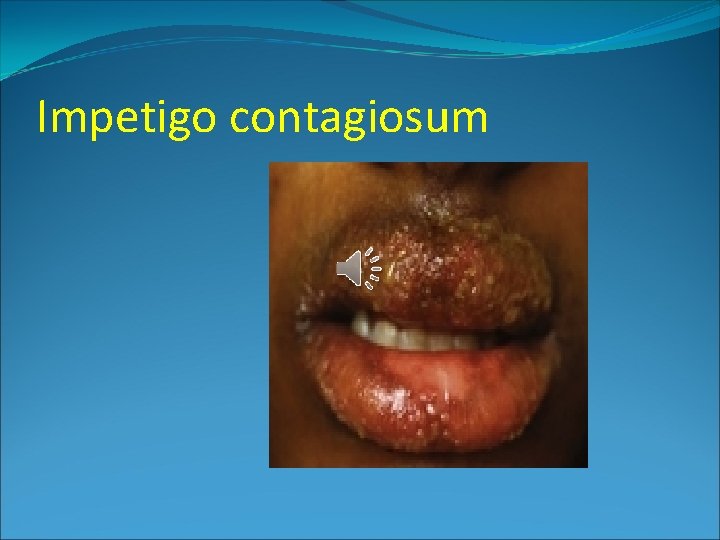 BACTERIAL SKIN DISEASES Prof Dr Eisha Abdel Moniem