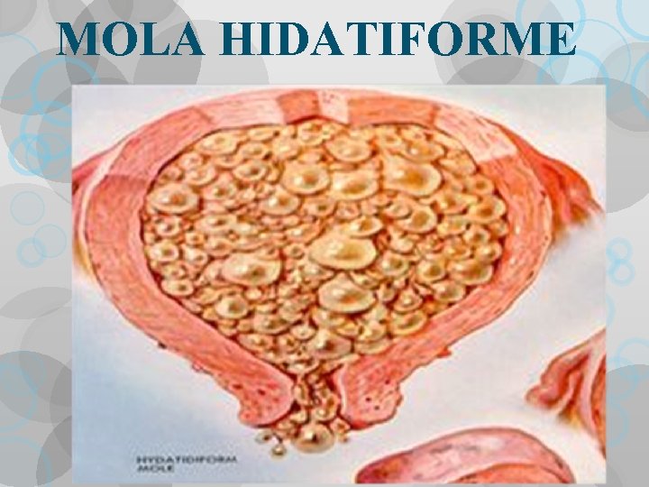 MOLA HIDATIFORME 