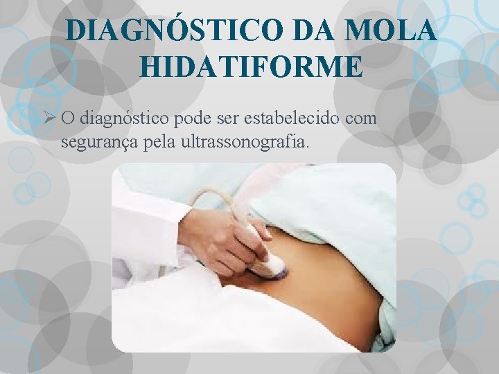 DIAGNÓSTICO DA MOLA HIDATIFORME Ø O diagnóstico pode ser estabelecido com segurança pela ultrassonografia.