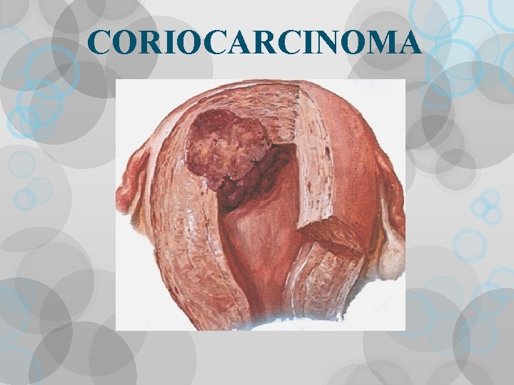 CORIOCARCINOMA 