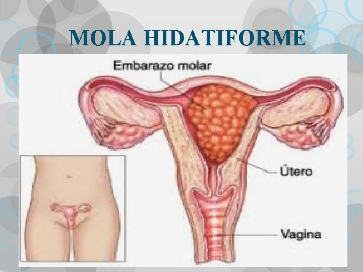 MOLA HIDATIFORME 