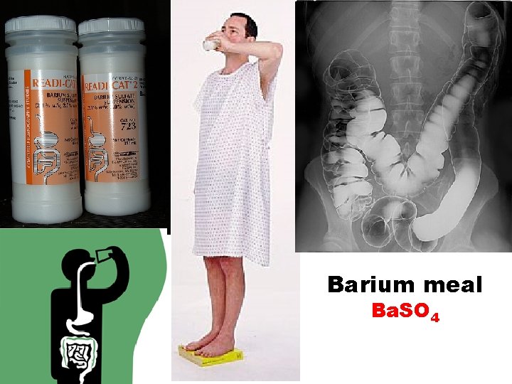 Barium meal Ba. SO 4 Barium meal Ba. SO 4