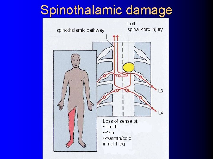 Spinothalamic damage spinothalamic pathway Left spinal cord injury Loss of sense of: • Touch