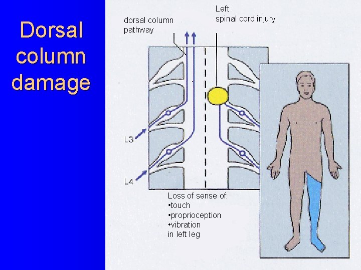 Dorsal column damage dorsal column pathway Left spinal cord injury Loss of sense of: