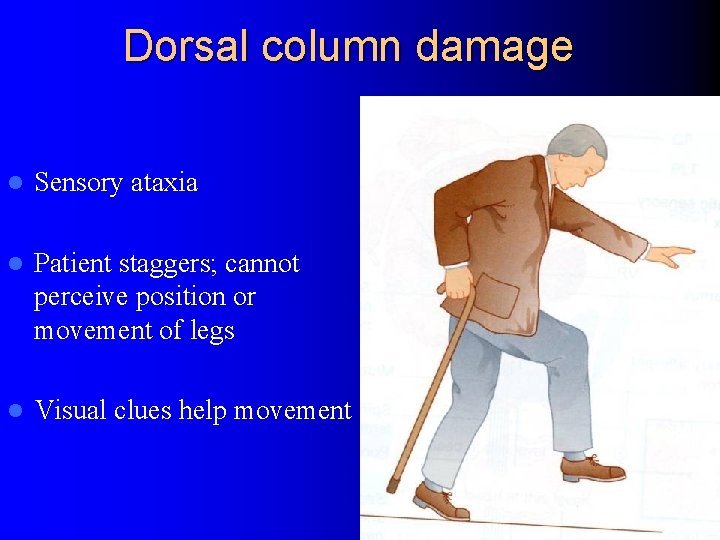 Dorsal column damage l Sensory ataxia l Patient staggers; cannot perceive position or movement