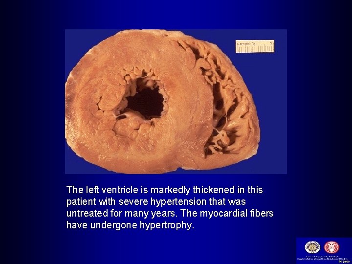 The left ventricle is markedly thickened in this patient with severe hypertension that was