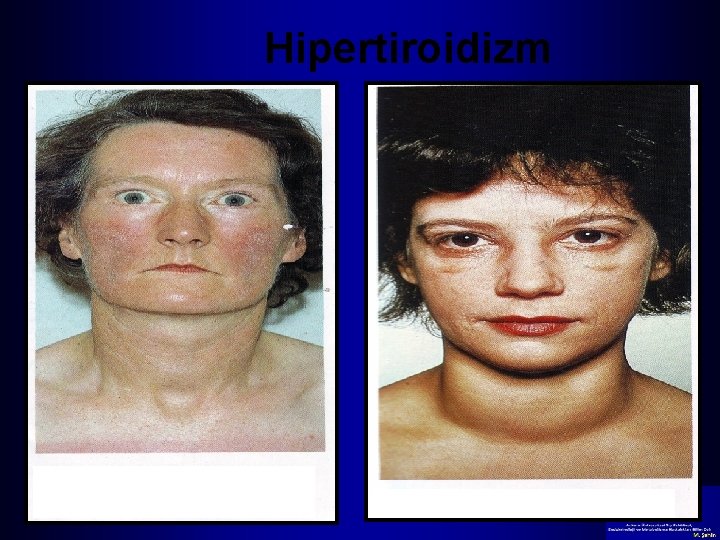 Hipertiroidizm 32 