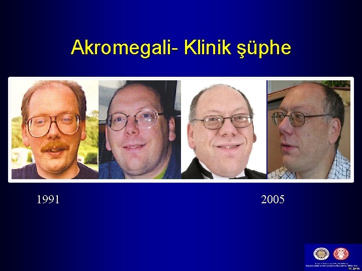 Akromegali- Klinik şüphe 1991 2005 