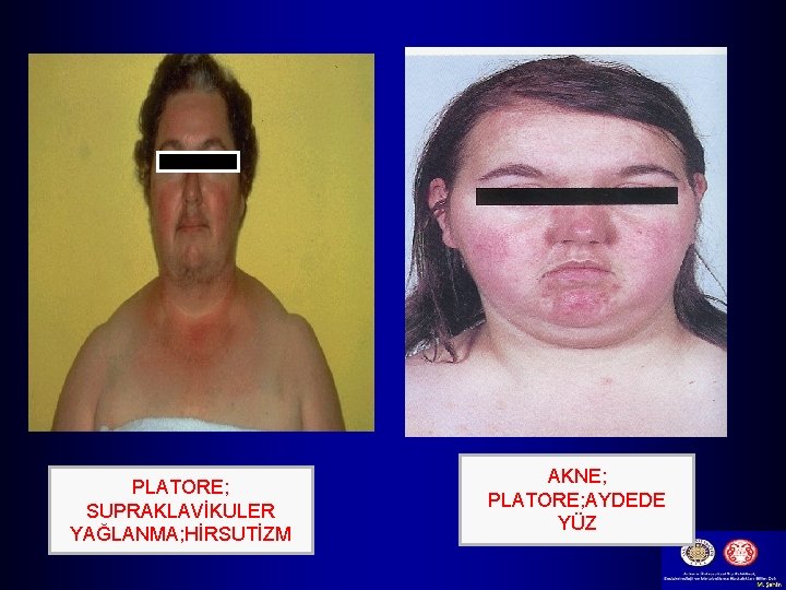 PLATORE; SUPRAKLAVİKULER YAĞLANMA; HİRSUTİZM AKNE; PLATORE; AYDEDE YÜZ 