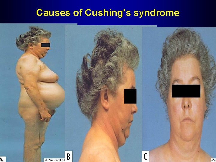 Causes of Cushing's syndrome 