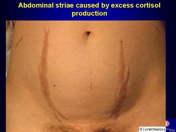 Abdominal striae caused by excess cortisol production 